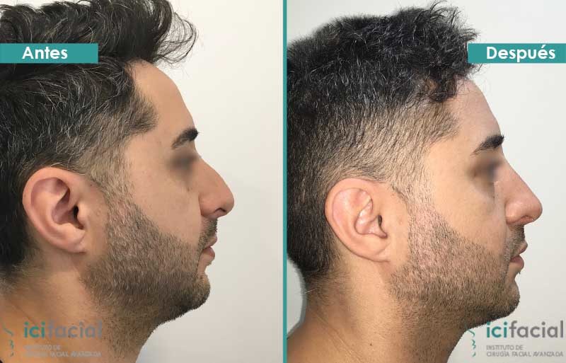 Rinoplastia en hombre antes y después