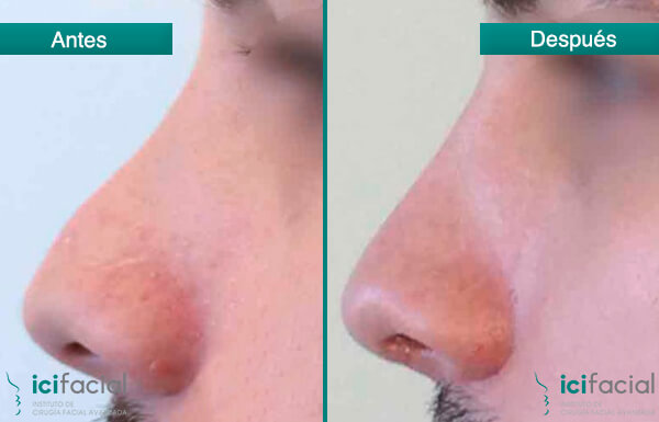 Hombre operado de rinoplastia en Icifacial