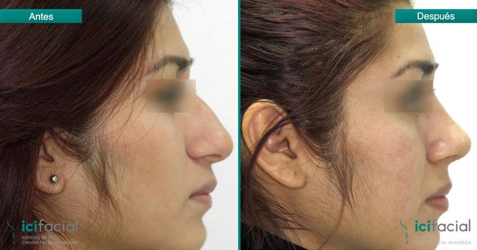 Rinoplastia mujer con reducción de giba dorsal