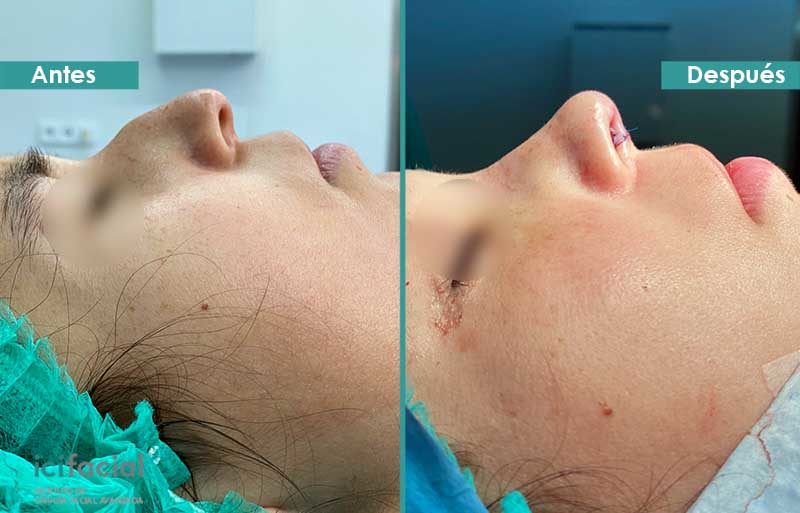 Rinoplastia ultrasónica justo antes y después de operación