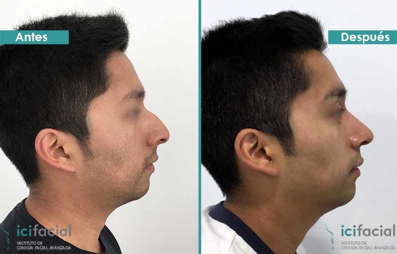 Rinoplastia Madrid antes y después por Dr Macia