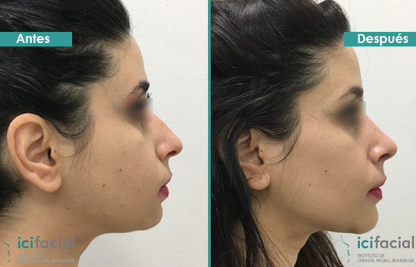 Rinoplastia de limado de caballete antes y después