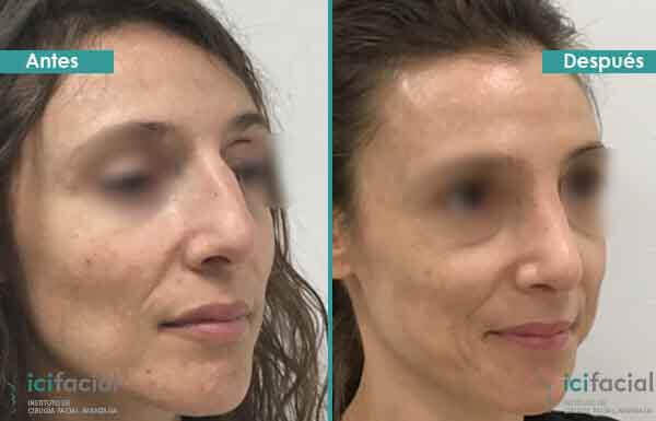 Cirguía de nariz en Madrid con limado de caballete