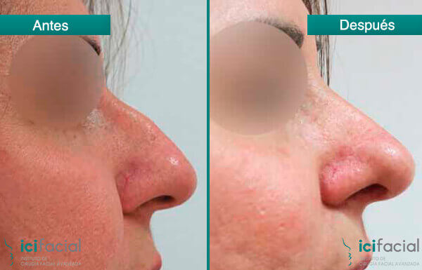 Rinoplastia en Madrid de mujer para limado de caballete