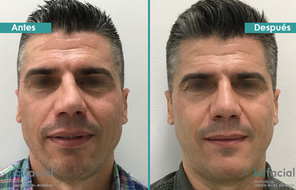 Rinoplastia Madrid con tecnica ultrasonica