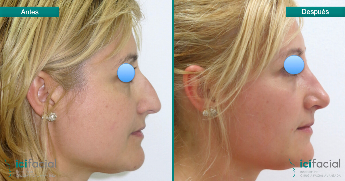 Rinoplastia mujer con reducción de giba dorsal