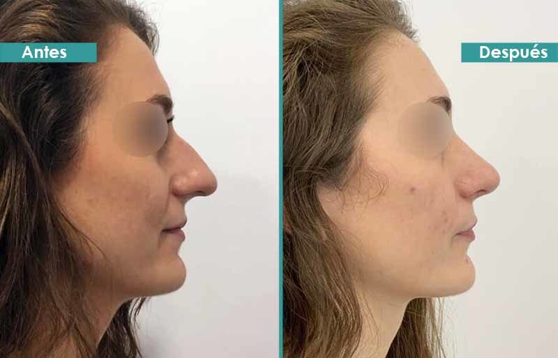 Rinoplastia dorso y punta caída