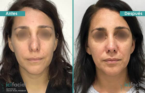 Rinoplastia secundaria antes y después en mujer operada en Icifacial