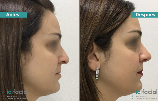 Rinoplastia ultrasónica