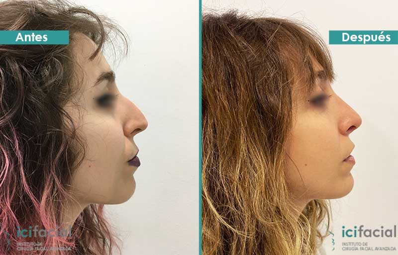 Rinoplastia ultrasonica en Madrid por Dr. Macia