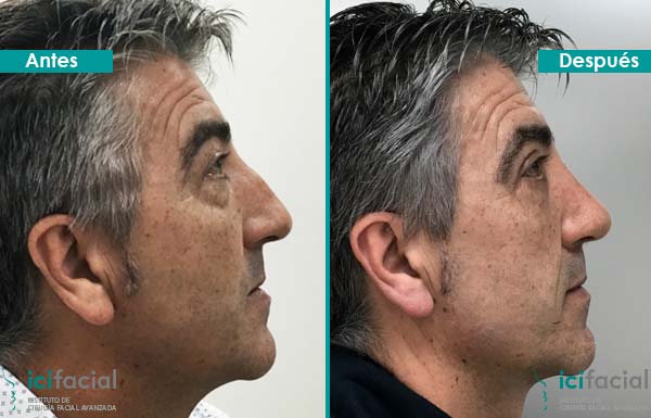 Rinoplastia en hombre operado en Madrid