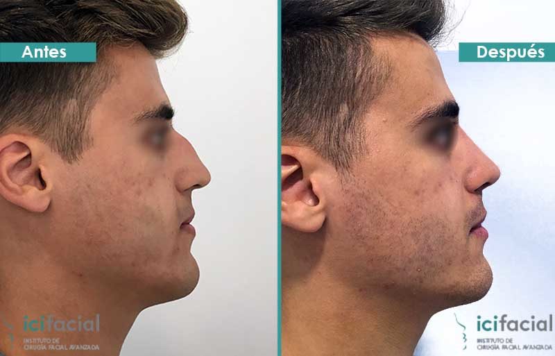 Rinoplastia ultrasónica antes y después