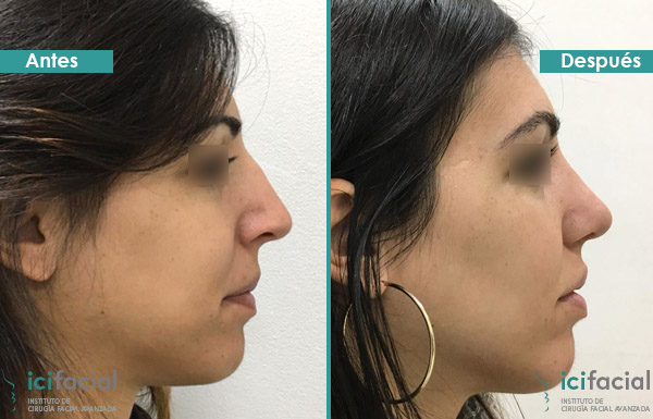 Rinoplastia por ultrasonidos