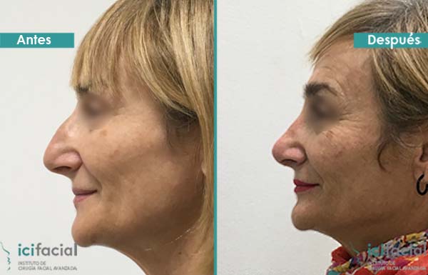 Rinoplastia en mujer para reducir el dorso