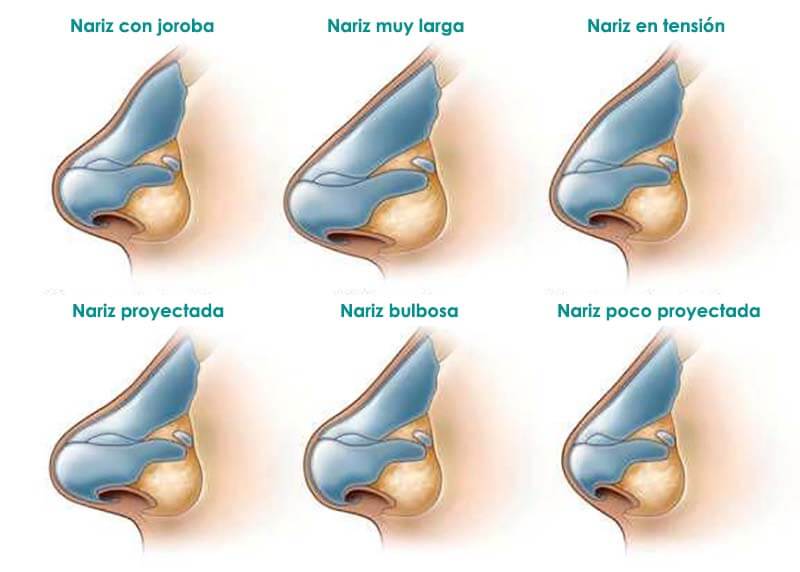 Tipos de nariz para la rinoplastia