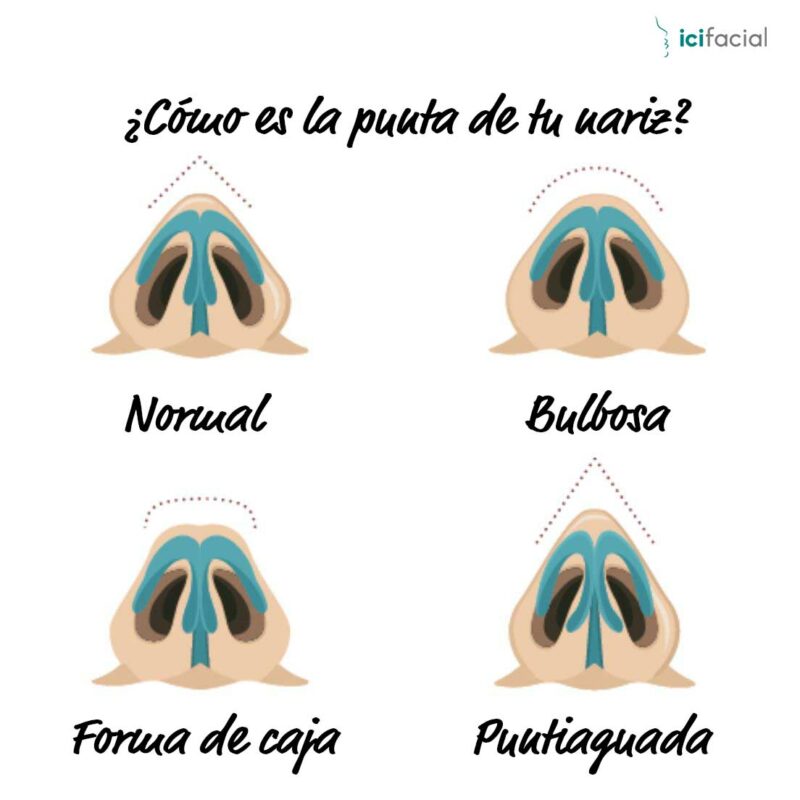 Tipos de punta nasal en rinoplastia