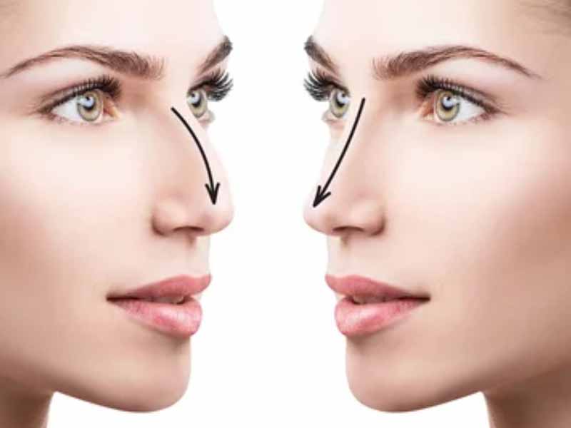 5 razones para operarse la nariz con rinoplastia