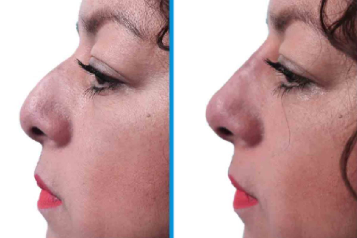 Rinoplastia para una punta caída