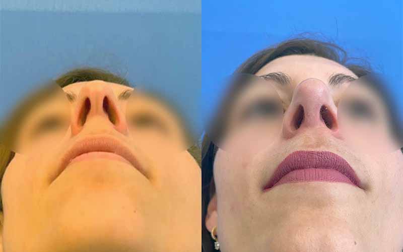 Alarplastia en rinoplastia