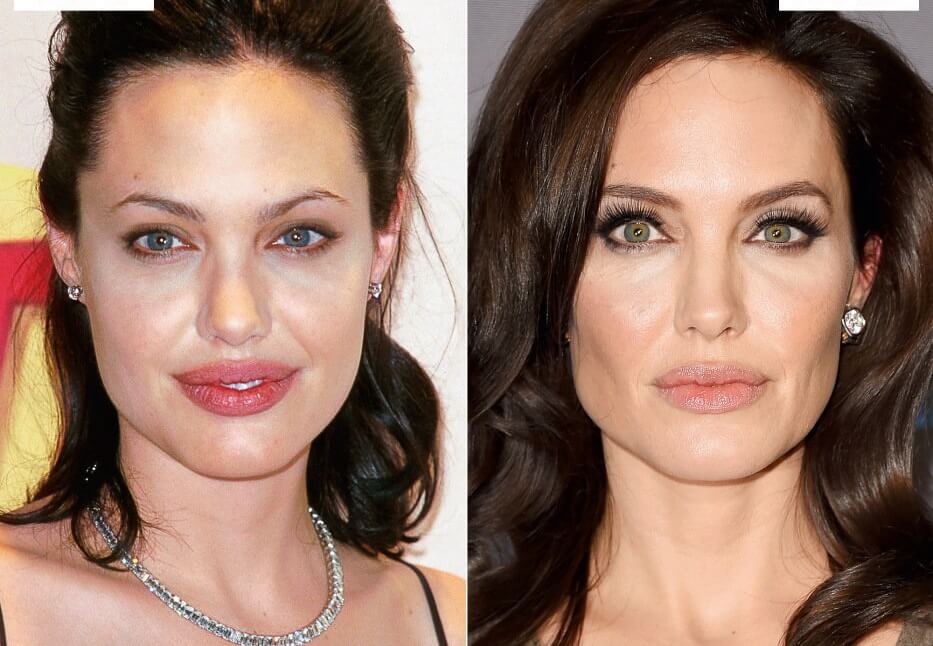 Bichectomía, la cirugía de moda entre los famosos.