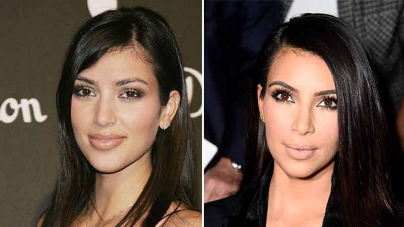 Bichectomía de Kim Kardashian con pómulos pronunciados