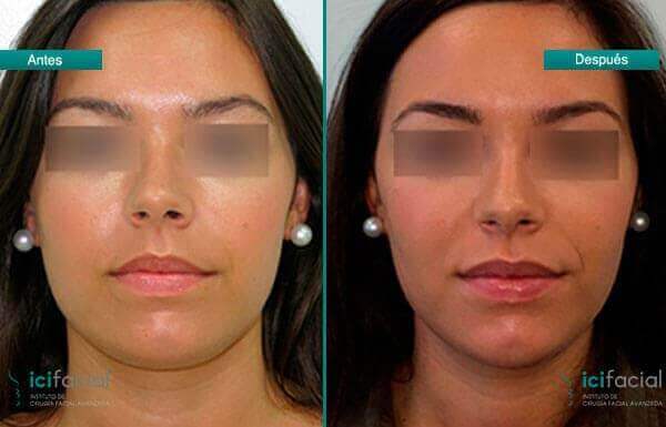 Bichectomía y lipo de papada para eliminar la grasa. El antes y después de una cichectomía