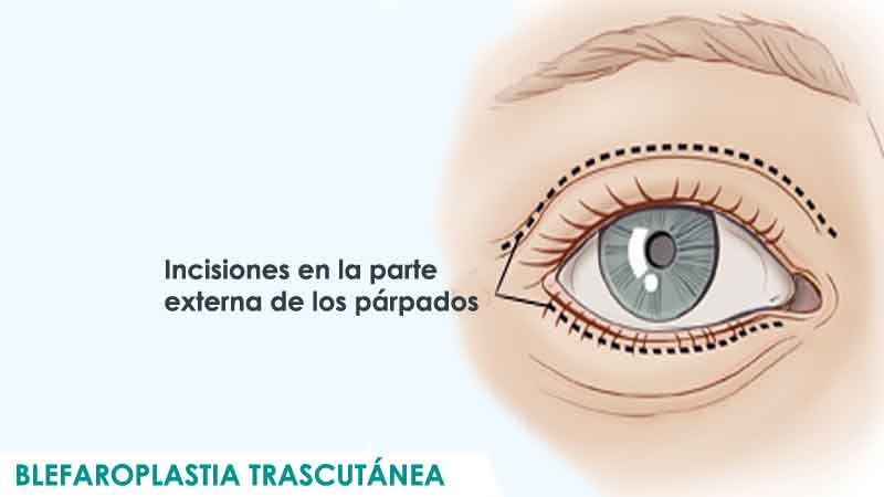 Blefaroplastia transcutánea en Madrid por Dr. Macía Colón