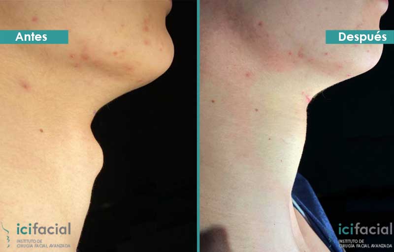 Feminización de la nuez de Adán