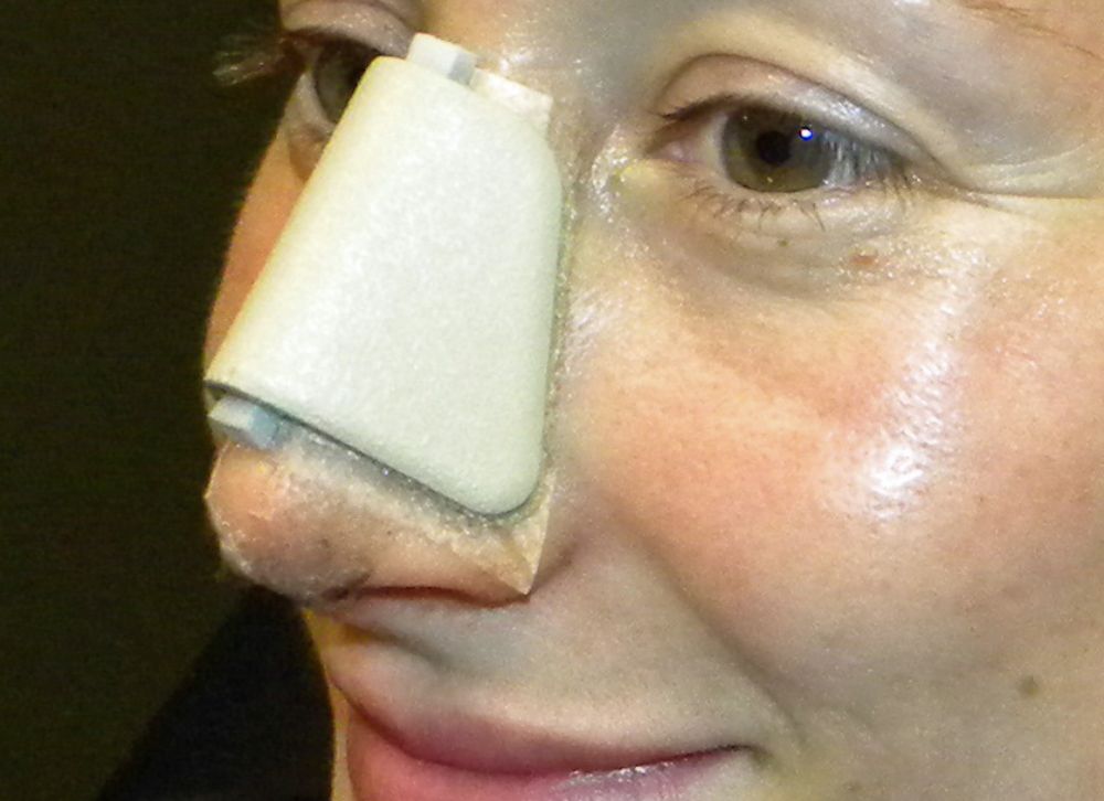 Las férulas nasales post rinoplastia