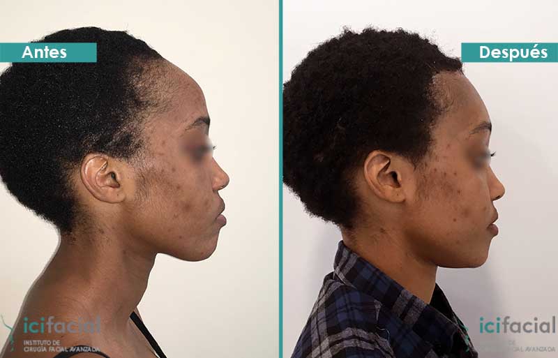 Frontoplastia de reducción de frente