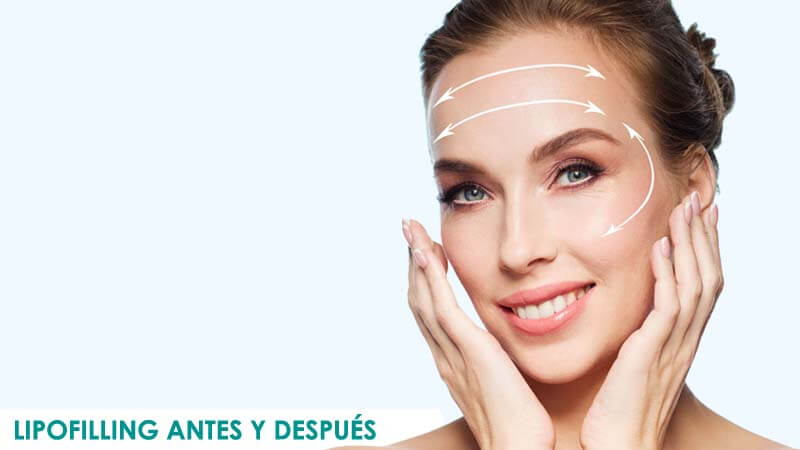 Fotos de lipofilling facial antes y después