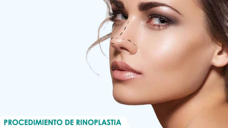 Procedimiento de rinoplastia por Dr. Macía