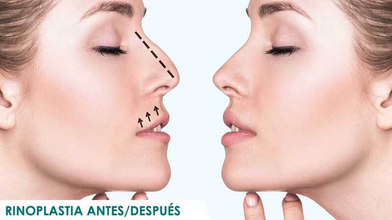Fotos rinoplastia antes y después