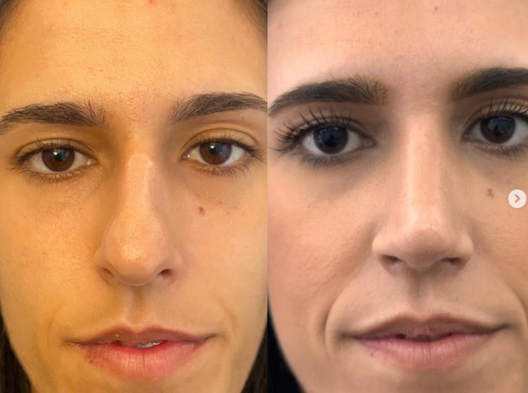 Rinoplastia de mujer con nariz bulbosa