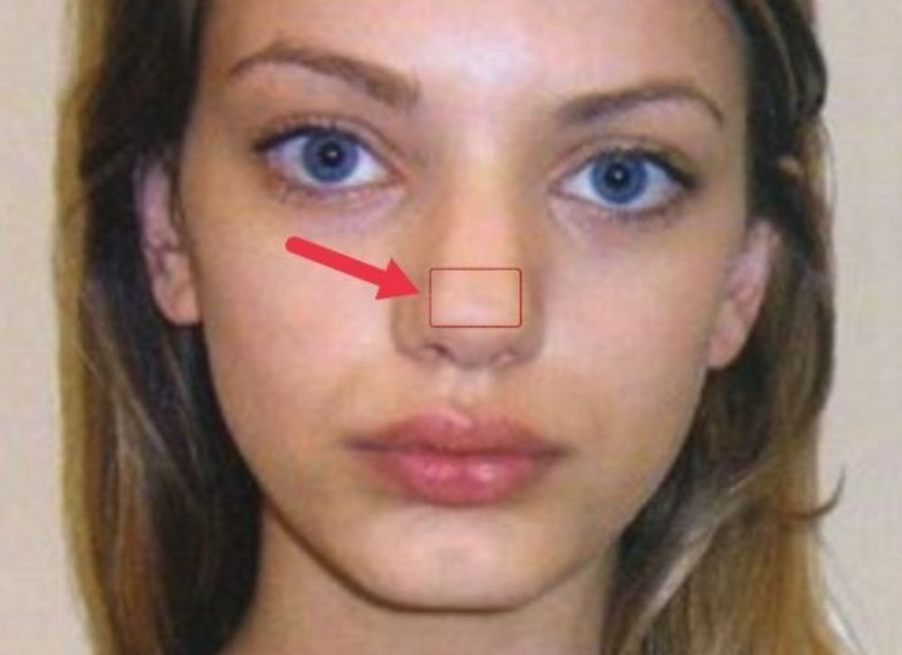 articulo sobre rinoplastia de nariz cuadrada