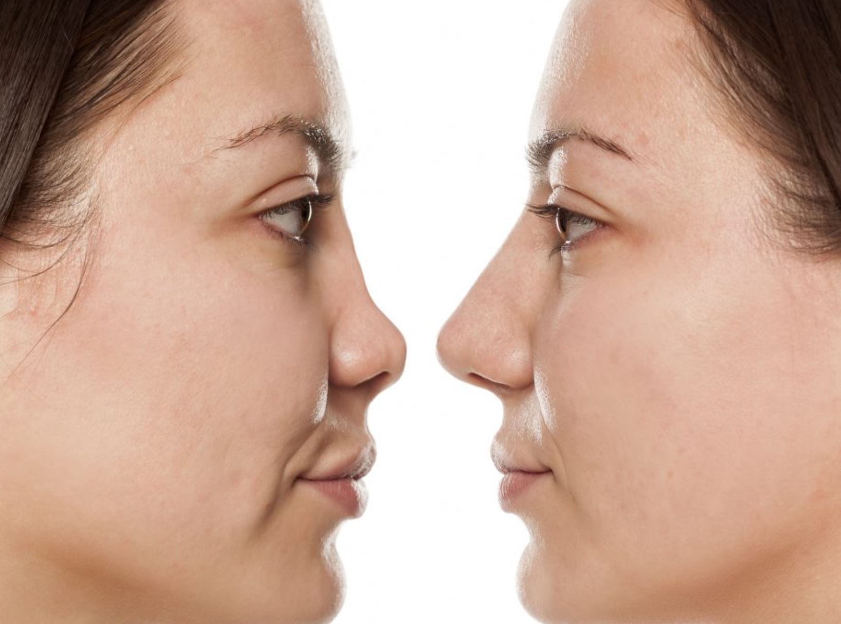 Ejemplo de rinoplastia fallida y corregida