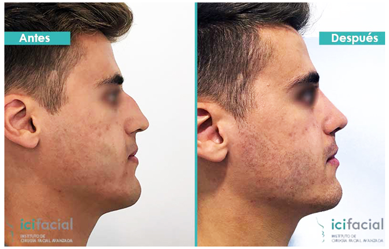 Beneficios de la rinoplastia ultrasónica: una rápida recuperación