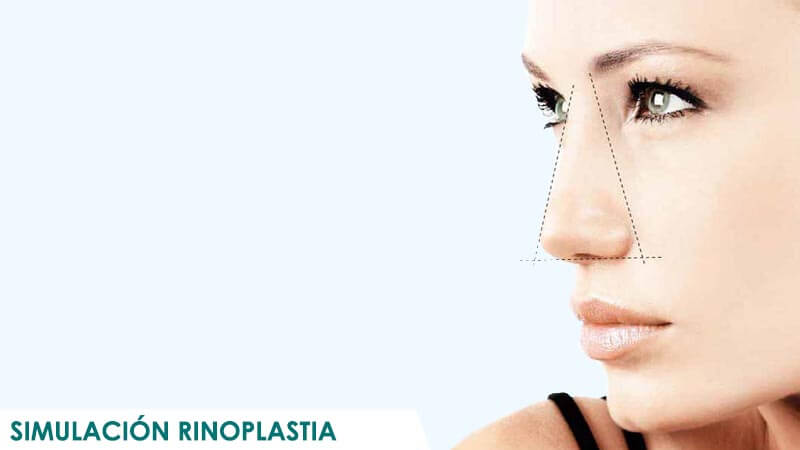 Simulación de rinoplastia en Madrid