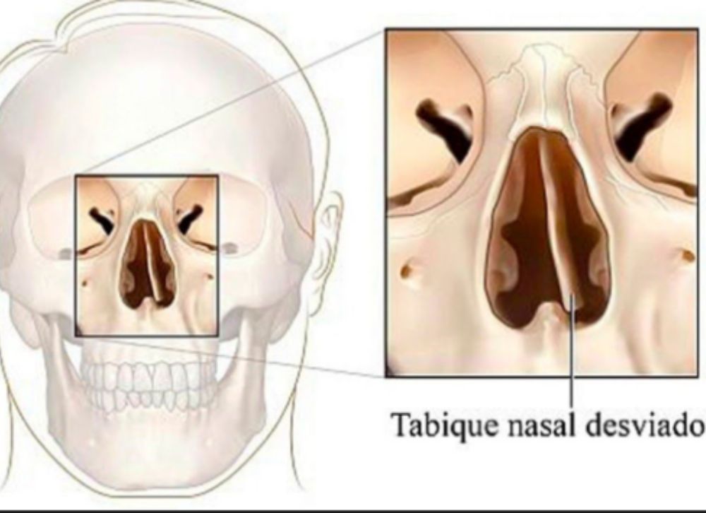 Corregir tabique nasal desviado con rinoplastia
