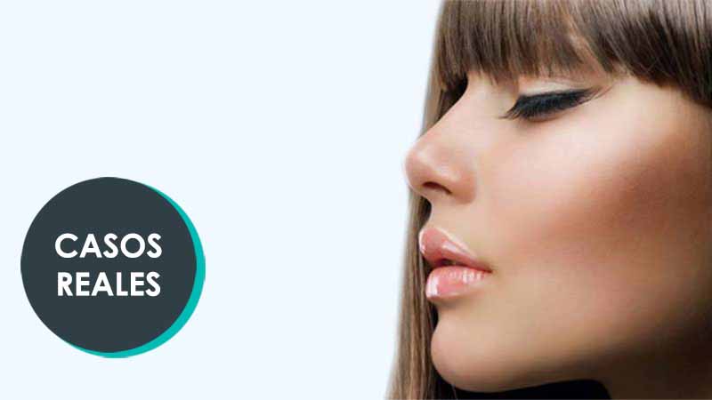 Opiniones de pacientes transexuales tras su operación de feminización facial con Dr. Macía