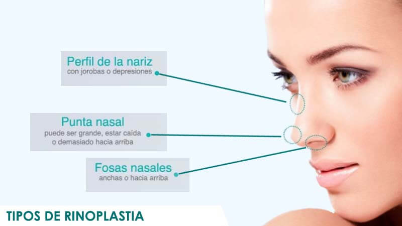 Tipos de rinoplastia y narices